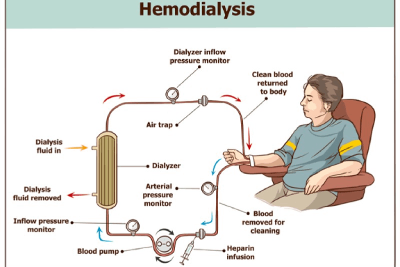 optofluid-technologies-kidney-dialysis-diagram